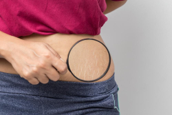 Cara Mengatasi Stretch Mark Saat Hamil dan Sesudah Melahirkan